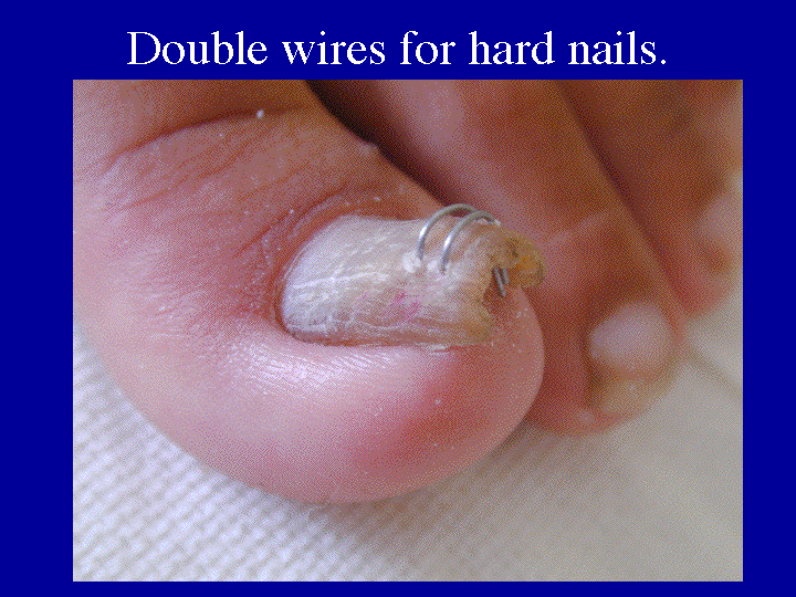 Slide 16 (hard nail)