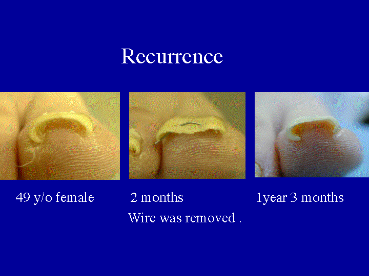 Slide 17 (recurrence)