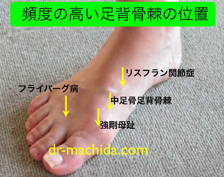 足背の骨棘　dorsal foot exostosis